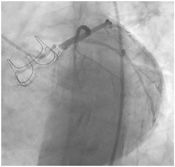 A Rare Complication Unveiled: Ostial Left Main Stenosis Post SAVR-A Case Report.