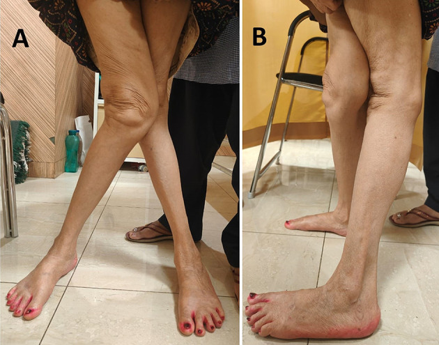 Robotic total knee arthroplasty for moderate to high-grade valgus knee deformity: technique and outcomes.