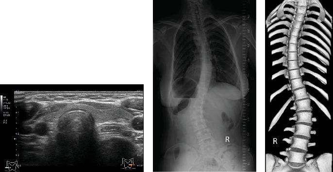 Successful Treatment With Evocalcet Against Familial Hypocalciuric Hypercalcemia Type 3 (FHH3) Identified by <i>AP2S1</i> Gene Mutation (p.Arg15Leu).