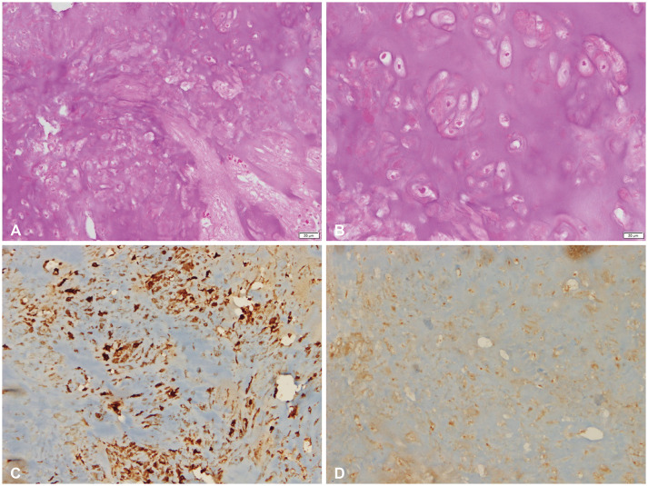 Para-Falcine Chondroma: An Entity of Unacquaintance-A Case Report and Review of Literature.