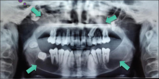 Gorlin-Goltz Syndrome with Jaw and Minimal Skin Manifestations - A Case Report.