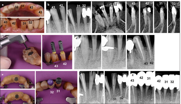 Effective Management of Calcified Root Canals Using Static-guided Access: A Case Series.