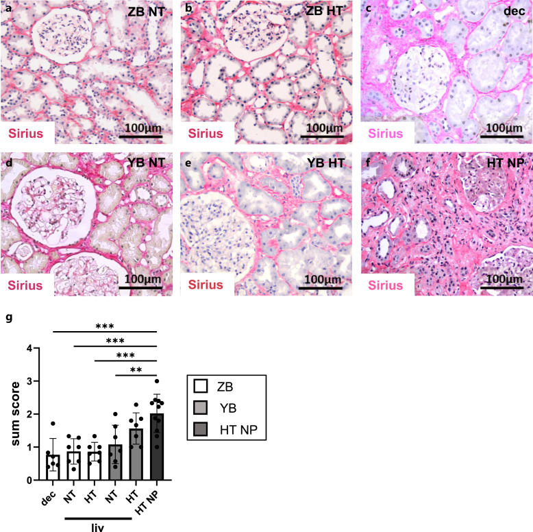 Hypertension in Living Kidney Donors Has No Effect on Complement Activation and Fibrosis.