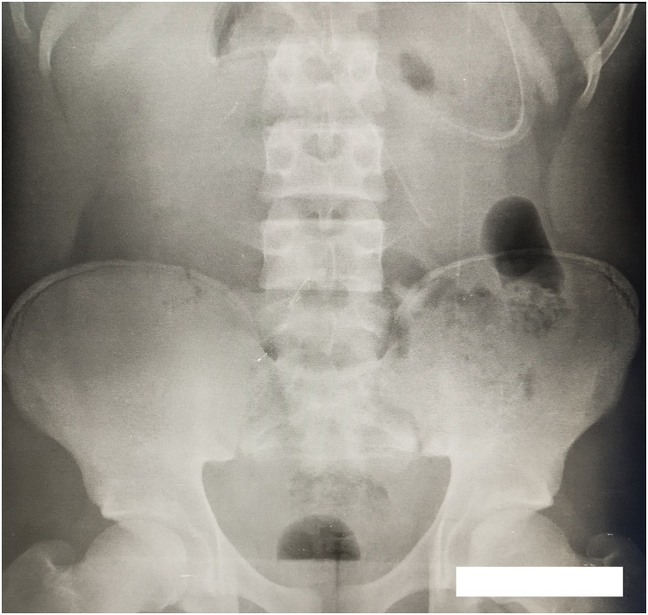 Meckel's Diverticulum Mimicking a Postoperative Flange with Acute Intestinal Obstruction and Midgut Volvulus: A Case Report.