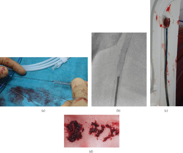 Novel Endovascular Technique for Thrombus Removal: The "Super Grab a Clot and Hold ON (Super GACHON)" Technique.