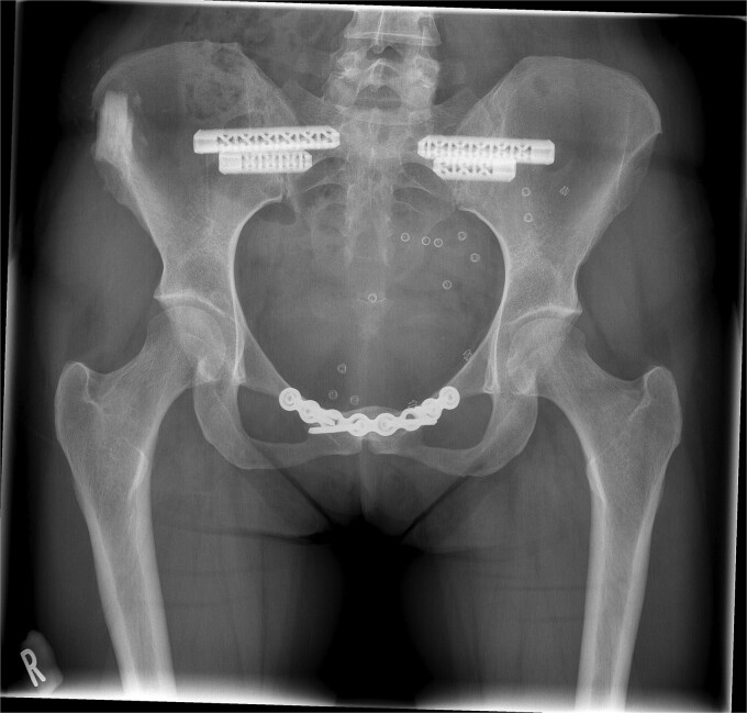 Safety and performance of a novel synthetic biomimetic scaffold for iliac crest defect reconstruction during surgical treatment of pelvic girdle pain: a first-in-human trial.