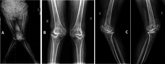 Robotic total knee arthroplasty for moderate to high-grade valgus knee deformity: technique and outcomes.