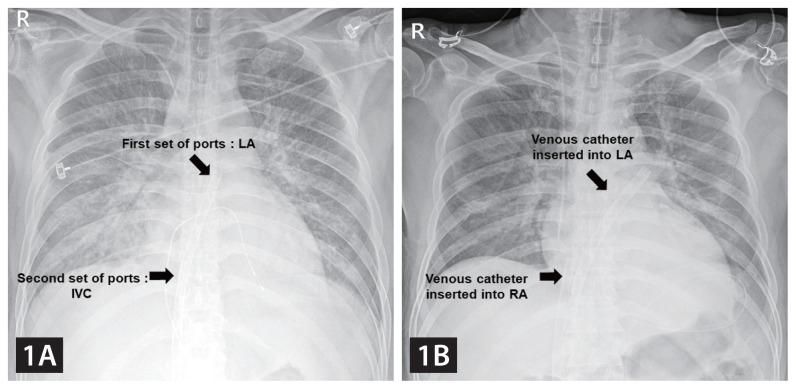 Femoral veno-arterial extracorporeal membrane oxygenation with a novel biatrial cannula for venous drainage and left ventricular venting.