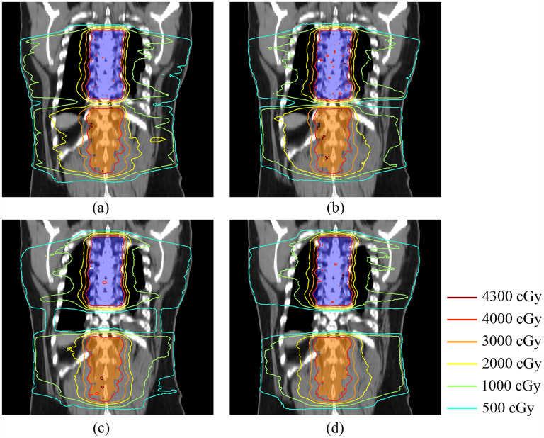 Impact of Intertarget Distances on Single-Isocenter Radiotherapy Plans with jaw-Tracking and jaw-Fixed Techniques for Vertebral Metastases.