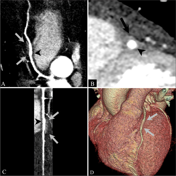 Novel case of coronary artery ectasia and myocardial bridging in one segment detected by coronary computed tomography angiography.