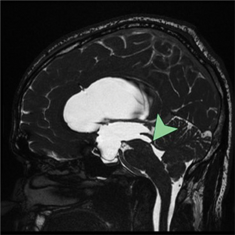 Late Presentation of Congenital Aqueduct Stenosis in Adulthood with High-Riding Basilar Artery: Case Report.