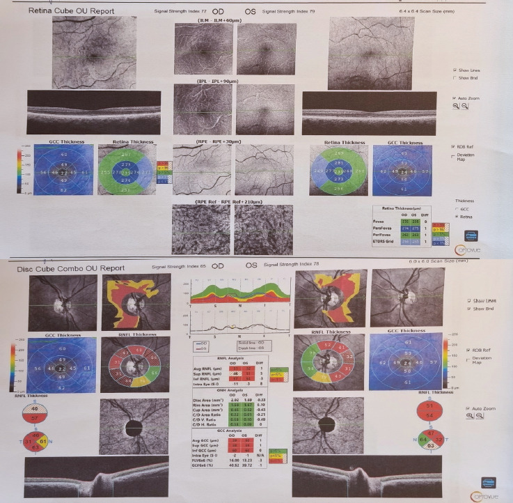 Leber's Hereditary Optic Neuropathy.