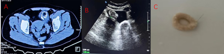 Mature Teratoma Combined with Bladder Stones: A Case Report and Literature Review.