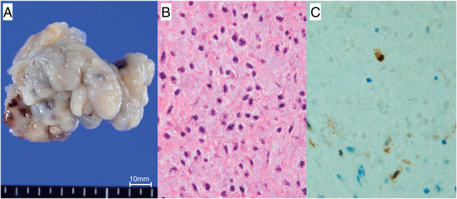 Primary Cardiac Myxofibrosarcoma: A Case Report.