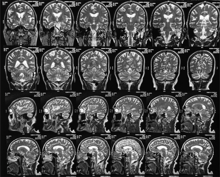 Distinctive lorazepam response in catatonia with cognitive impairment.