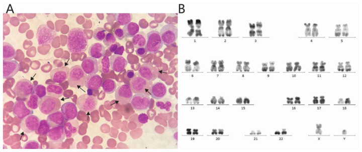 Fusion Gene Landscape in a Case of Acute Myelocytic Leukemia with Myelocyte Morphology.