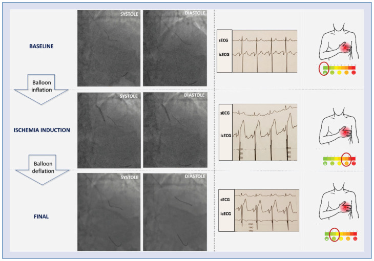 Rationale and design of the MICE study: Exploration of the temporal relation between electrical and mechanical events during myocardial ischemia.
