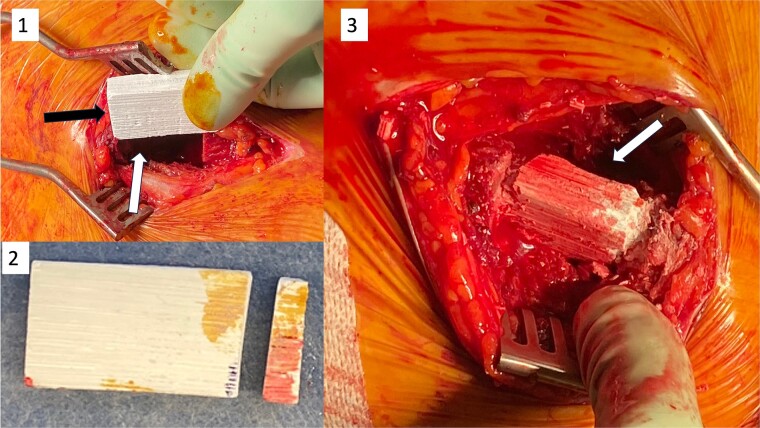 Safety and performance of a novel synthetic biomimetic scaffold for iliac crest defect reconstruction during surgical treatment of pelvic girdle pain: a first-in-human trial.