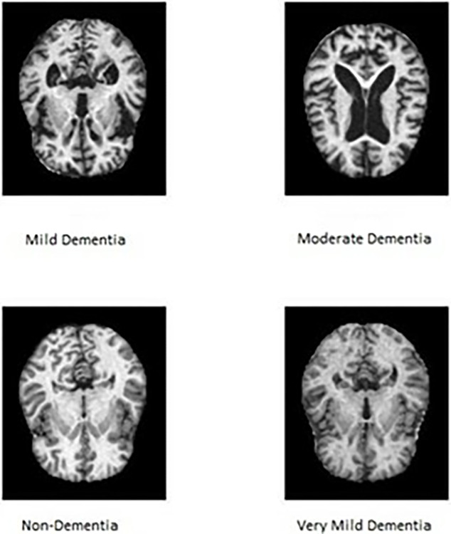 Alzheimer's disease image classification based on enhanced residual attention network.