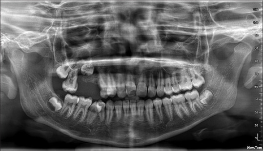Central Giant Cell Granuloma of Posterior Maxilla - A Case Report.