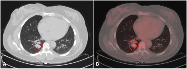 Brain Metastasis as the Initial Presentation of Carcinoid Tumor: Case Report and Literature Review.