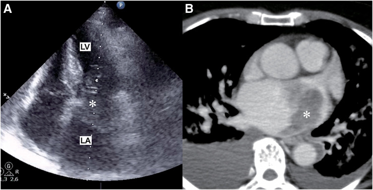 Primary Cardiac Myxofibrosarcoma: A Case Report.