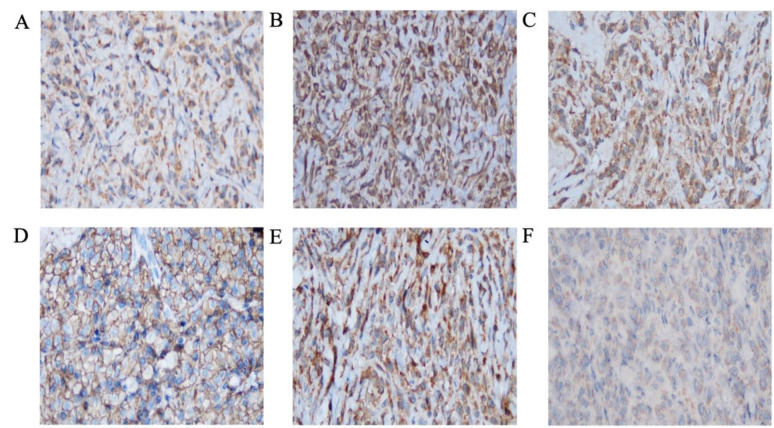 A Case of Amelanotic Plasmacytoid Melanoma with Strong CD138 Expression, Mimicking Multiple Myeloma - A Case Report.