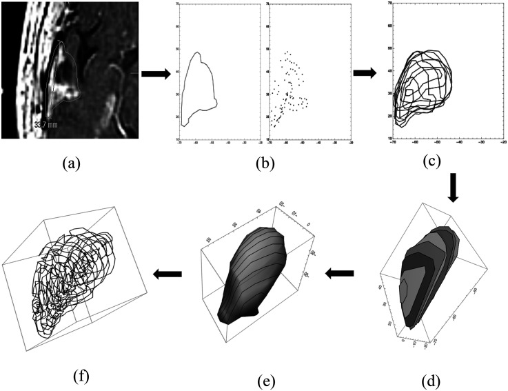 Spot-Scanning Confocal Photon Beams for Hypofractionated Brain Radiosurgery.