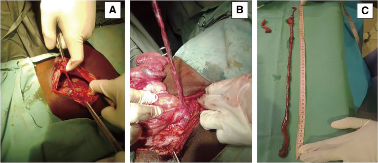 Meckel's Diverticulum Mimicking a Postoperative Flange with Acute Intestinal Obstruction and Midgut Volvulus: A Case Report.