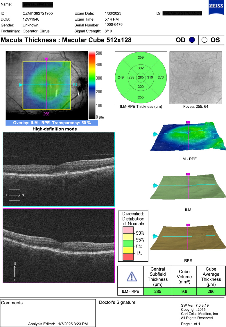 Cefuroxime-Induced Toxic Maculopathy after Intracameral Injection of Standard Dose: A Case Report.