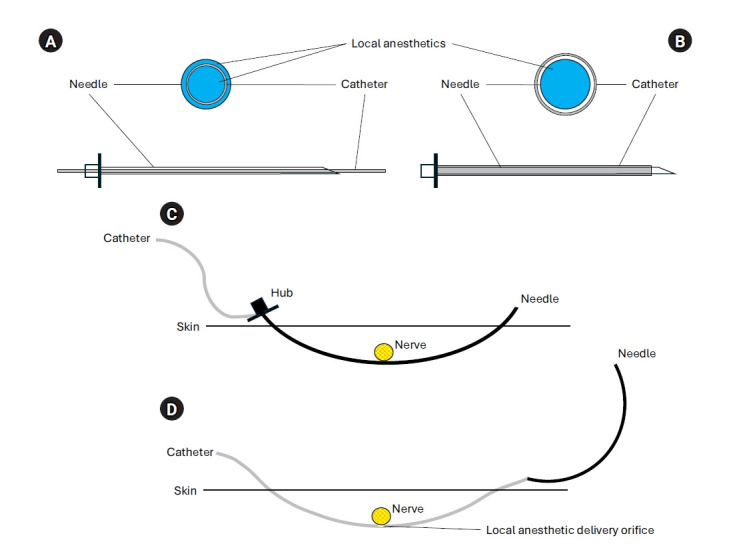 Perineural catheters for continuous peripheral nerve blocks: a narrative review.
