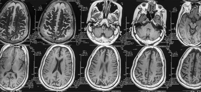Alcohol dependent and GTCS patient with sleep-related hyper motor epilepsy.