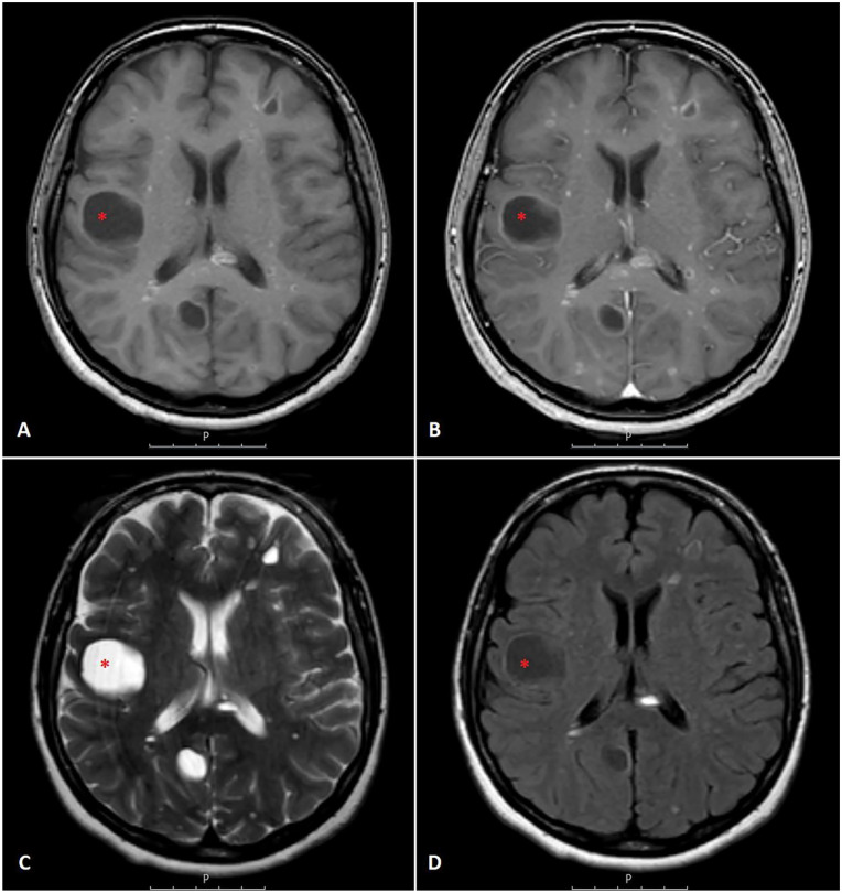 Brain Metastasis as the Initial Presentation of Carcinoid Tumor: Case Report and Literature Review.
