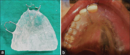 Three Fixation Techniques of Immediate Surgical Obturators Following Maxillectomy - A Comparative Study.