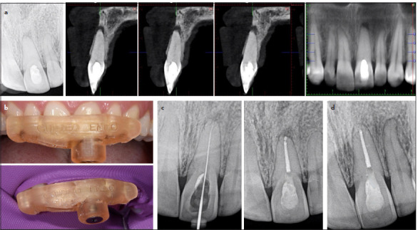 Effective Management of Calcified Root Canals Using Static-guided Access: A Case Series.