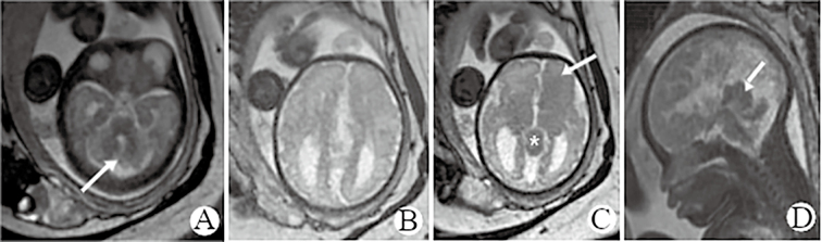 Clinical Observation on Orbital Teratoma of Delleman Syndrome Diagnosed by Fetal MRI Without Cutaneous Manifestations.