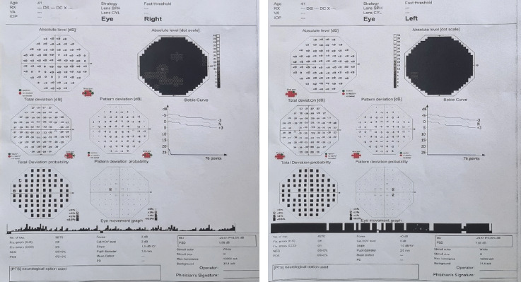Leber's Hereditary Optic Neuropathy.