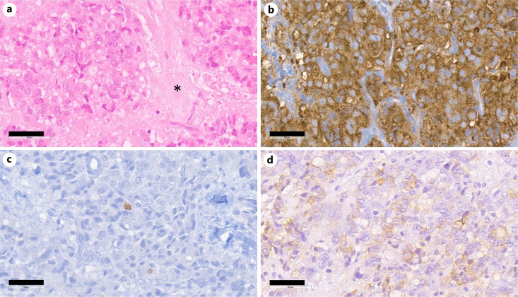 Ectopic Corticotropin-Releasing Hormone/Adrenocorticotropic Hormone-Co-Secreting Neuroendocrine Tumors Leading to Cushing's Disease: A Case Presentation and Literature Review.