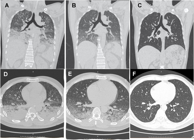 A rare case of acute respiratory distress syndrome due to chlorine gas inhalation: Rapid progression with favorable ICU outcome