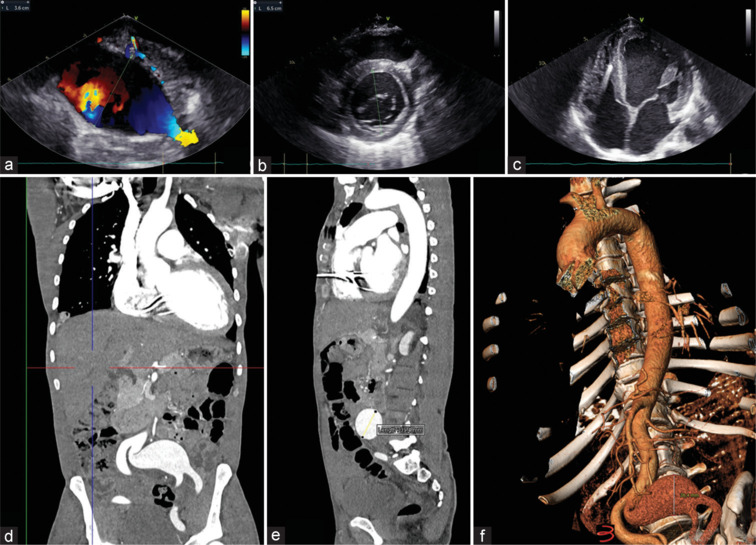 Isolated Common Iliac Aneurysm and Dilated Left Ventricle: Kill Two Birds with One Stone?