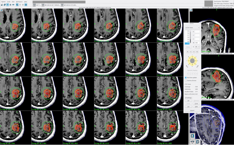 Spot-Scanning Confocal Photon Beams for Hypofractionated Brain Radiosurgery.