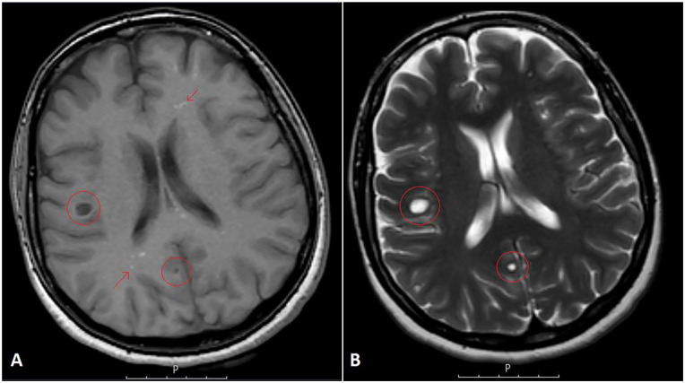 Brain Metastasis as the Initial Presentation of Carcinoid Tumor: Case Report and Literature Review.
