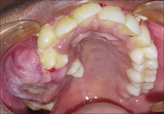 Central Giant Cell Granuloma of Posterior Maxilla - A Case Report.