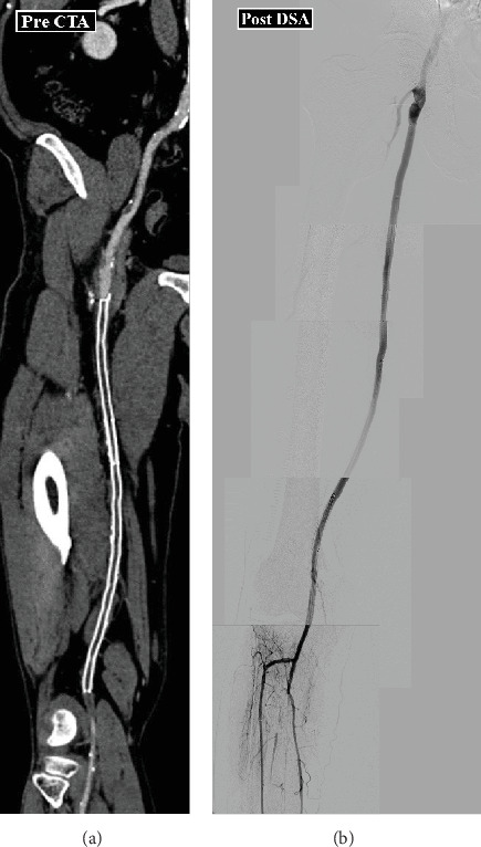 Novel Endovascular Technique for Thrombus Removal: The "Super Grab a Clot and Hold ON (Super GACHON)" Technique.