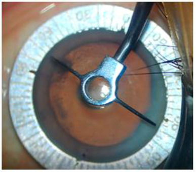 A prospective study to compare the safety and efficacy of toric intra-ocular lens vs. opposite clear corneal incision in patients undergoing phacoemulsification for age-related cataract with pre-existing corneal astigmatism.