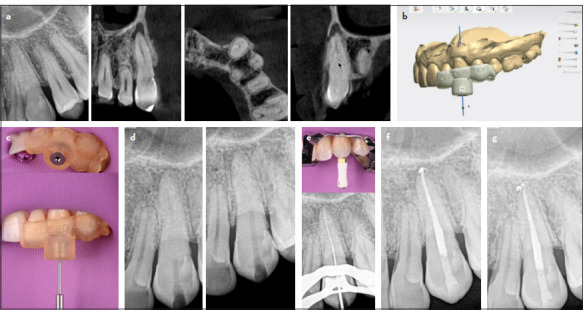 Effective Management of Calcified Root Canals Using Static-guided Access: A Case Series.