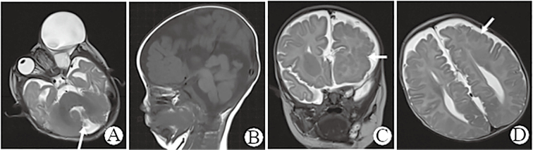 Clinical Observation on Orbital Teratoma of Delleman Syndrome Diagnosed by Fetal MRI Without Cutaneous Manifestations.