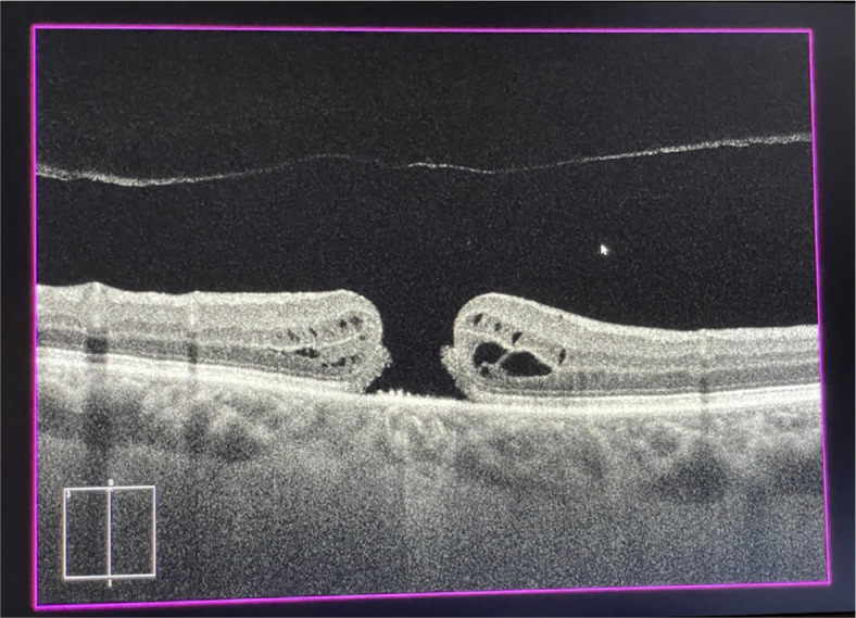 Surgical maculopathies: epiretinal membranes and full-thickness macular holes.