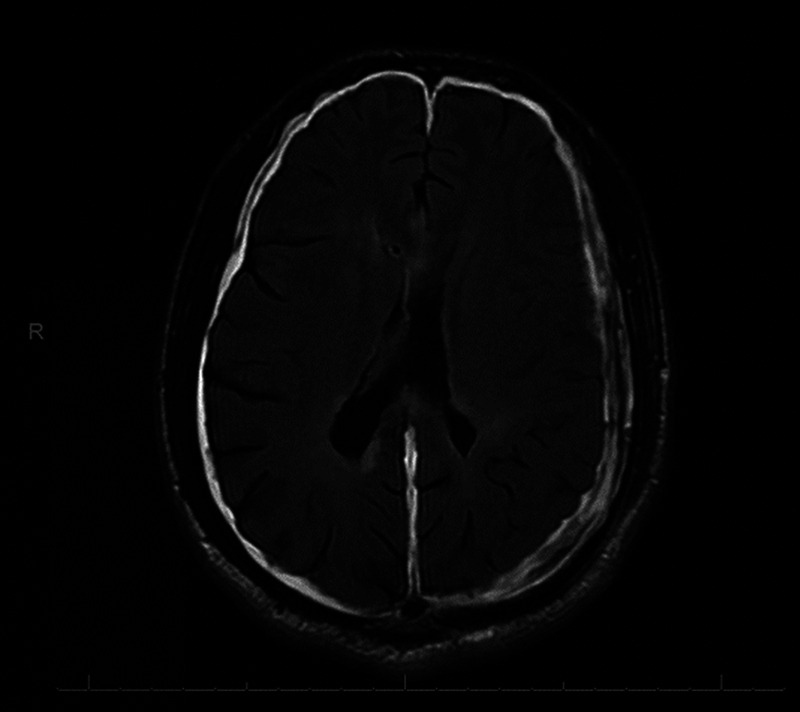 Late Presentation of Congenital Aqueduct Stenosis in Adulthood with High-Riding Basilar Artery: Case Report.