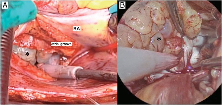 Primary Cardiac Myxofibrosarcoma: A Case Report.